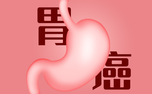 女子陪丈夫复查发现自己早期胃癌，现在胃癌早期有哪些症状？