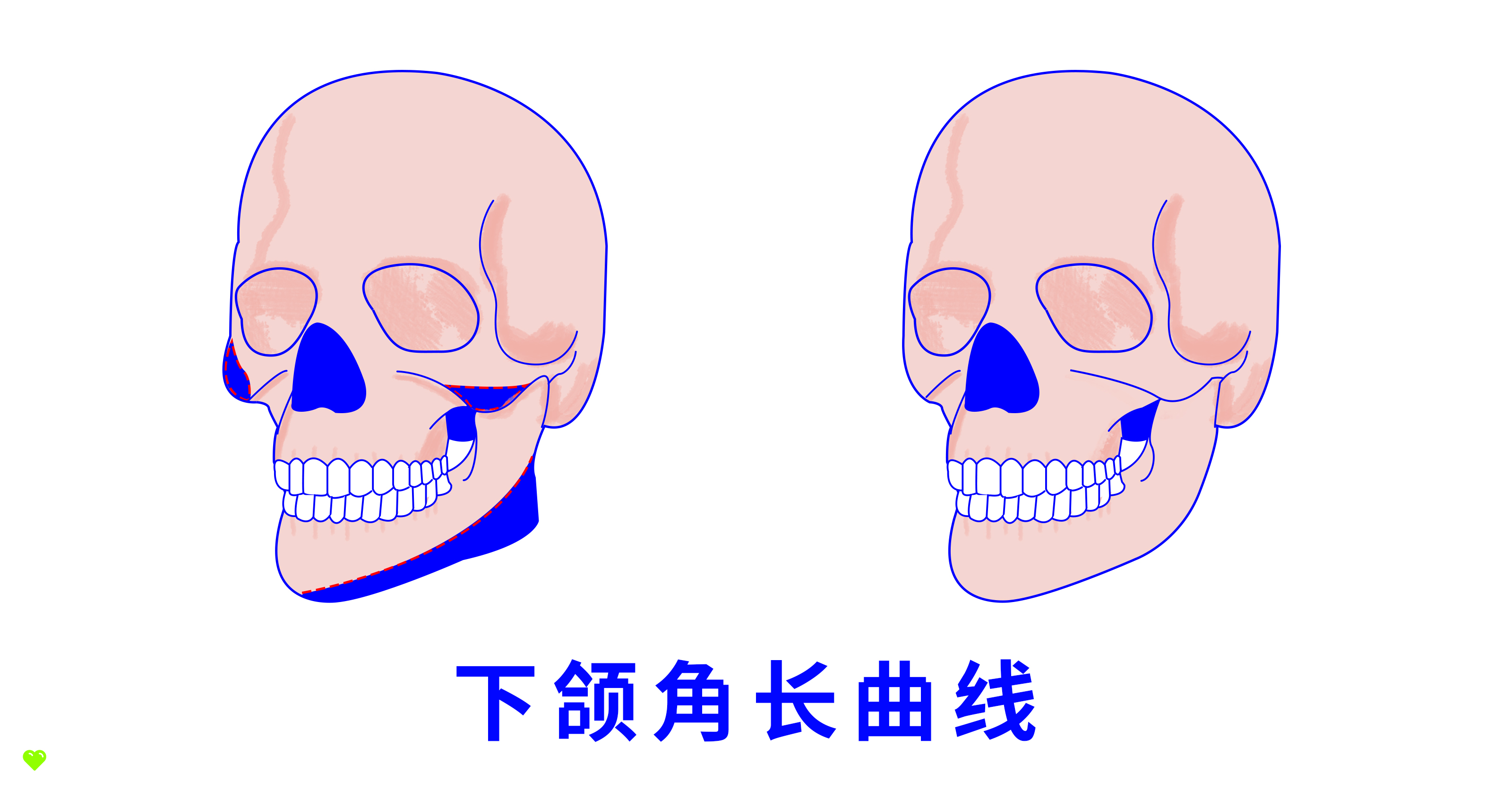 下颌角整形术后恢复期，有哪些注意事项？