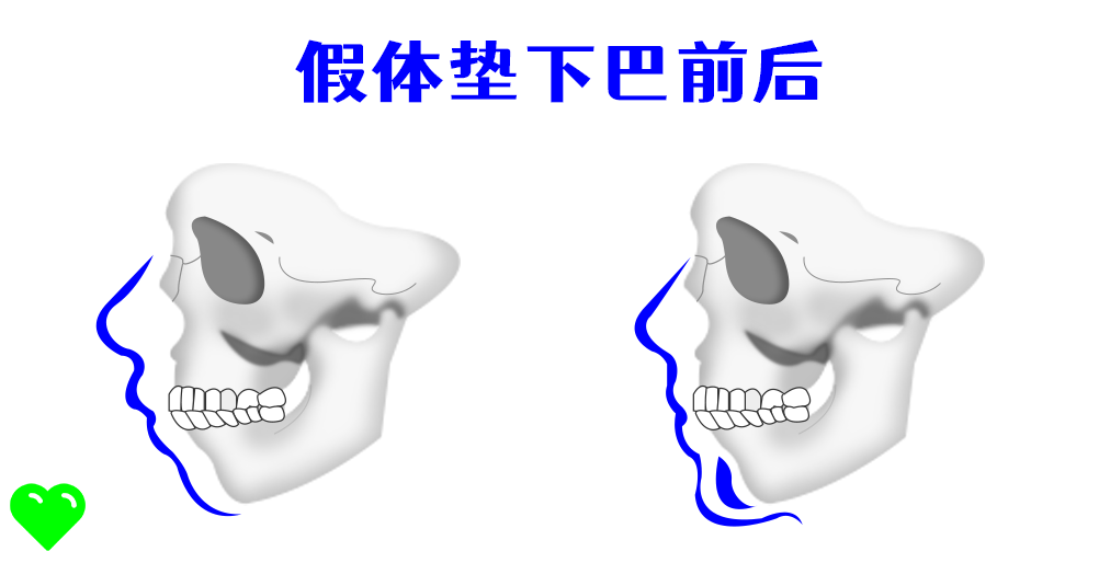硅胶垫下巴会不会越来越短？