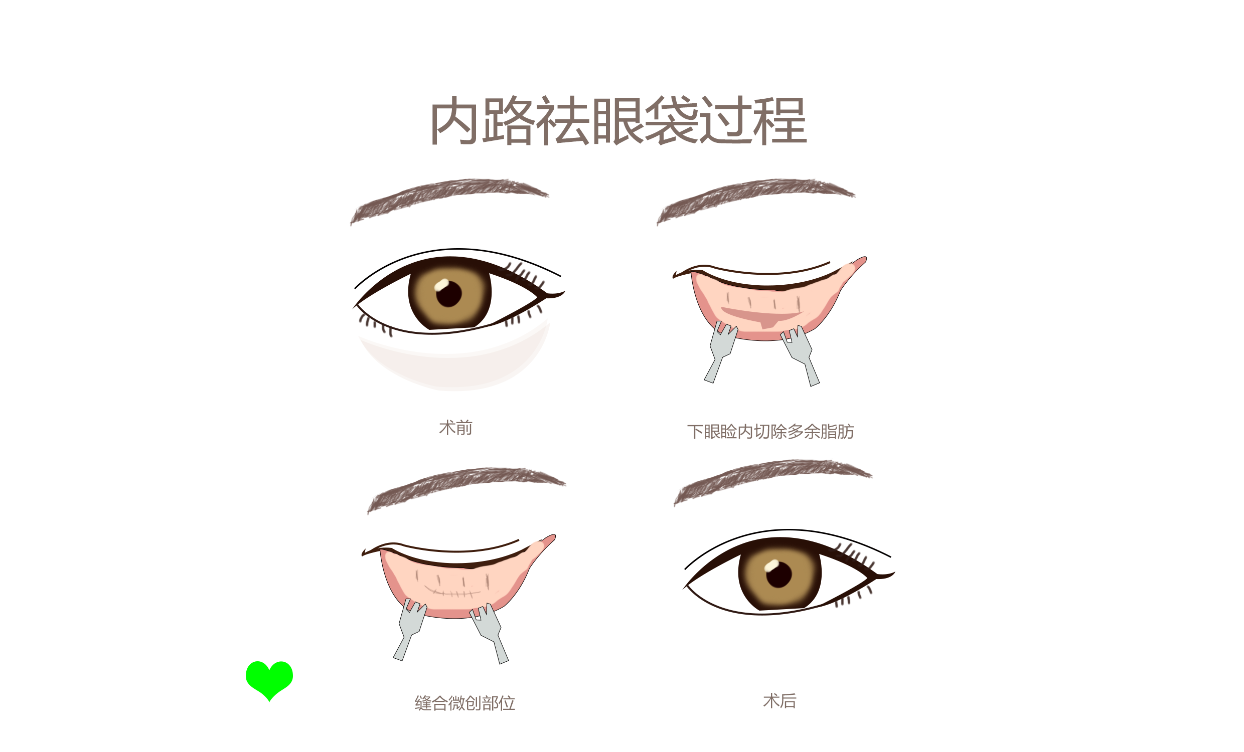 西安画美内切眼袋后如何快速消肿？内切眼袋后忌口多久？