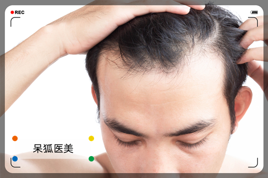 植发后毛囊多久稳固？湖北植发哪家医院好？