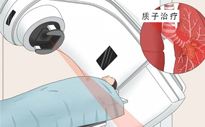 质子治疗适用于哪些肿瘤？