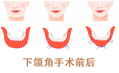 下颌角缩小术会留疤吗？