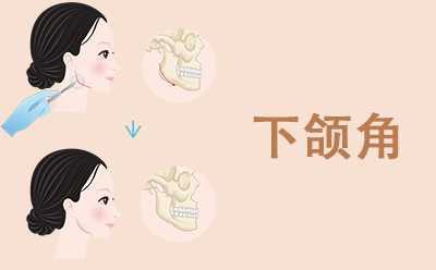 下颌角手术后还会长回来吗？