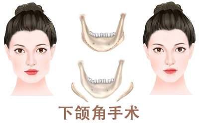 下颌角手术多久消完肿？