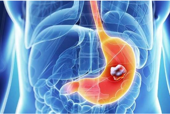 什么是5年存活（生存）率？