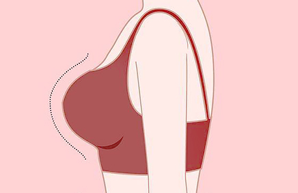 乳房整形